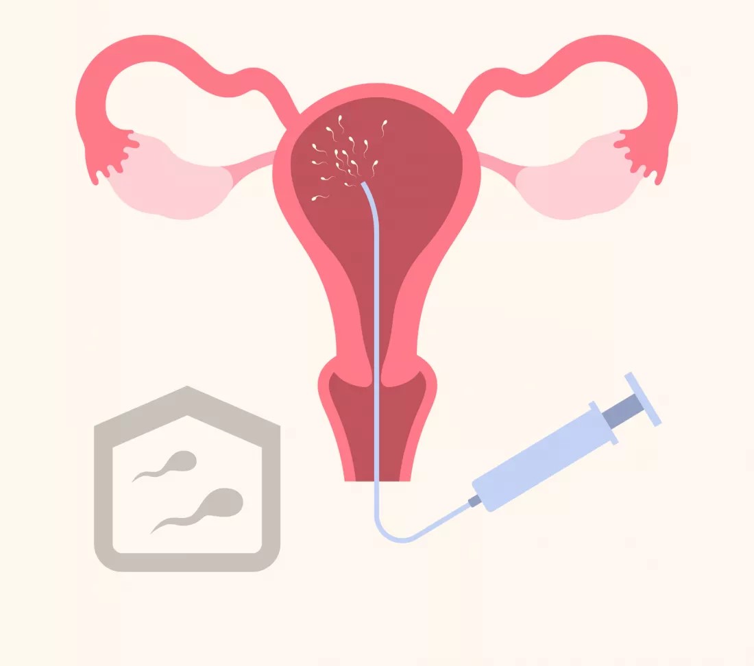 Top 8 Advantages of Intrauterine Insemination (IUI) in Fertility Care