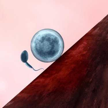 Male Infertility Image